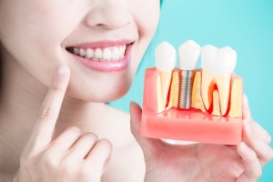 Full arch dental implant services at Premier Oral Surgery in Englewood Cliffs and Bergenfield, NJ.